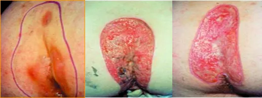 pilonidal sinus